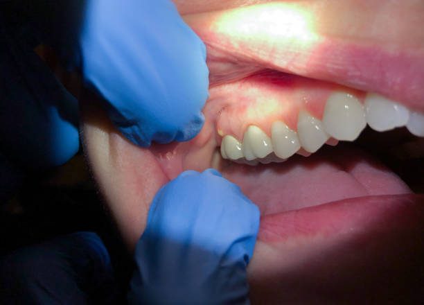 Best Emergency Dentist for Knocked-Out Tooth in Schenectady, NY
