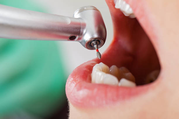 Best Emergency Dentist for Lost Fillings or Crowns in Schenectady, NY